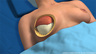 Breast Reconstruction Healing Matrix Image