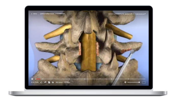 Lumbar - Laminectomy, Fusion - Instrumented Animation