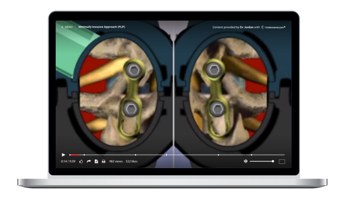 Lumbar - Minimally Invasive Approach (PLIF) Animation