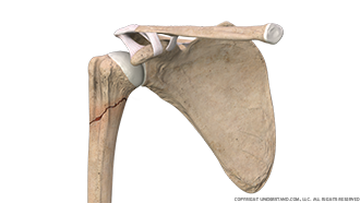 Humeral Fracture Anterior Image
