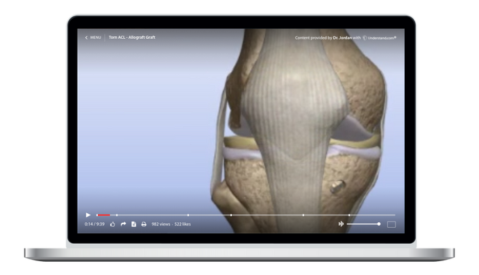 Torn ACL - Allograft Animation