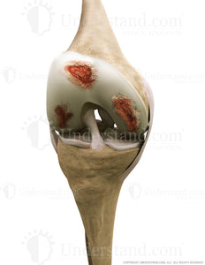 Knee Osteoarthritis Anterior Flexed Image
