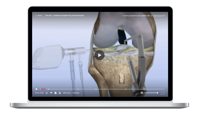 Torn ACL - Anatomic Footprint ACL Reconstruction Animation