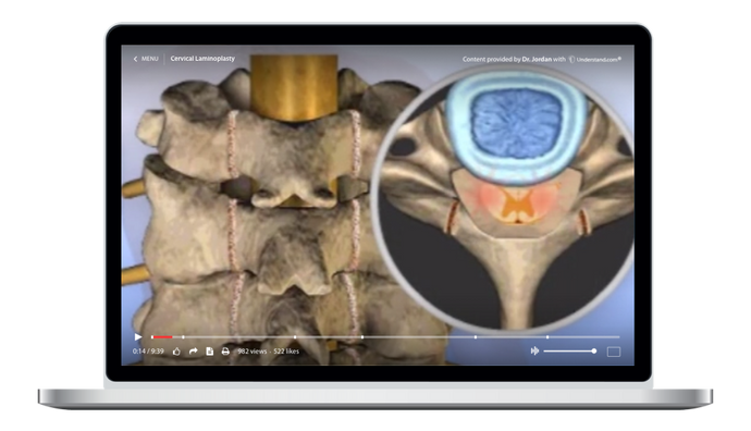 Cervical - Cervical Laminoplasty Animation