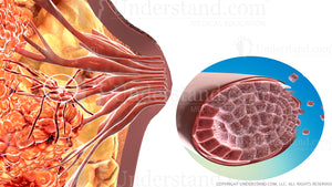 Breast Cancer Invasive Carcinoma Image