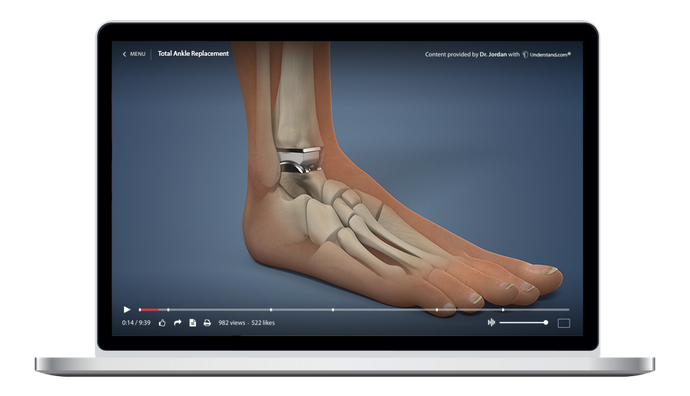 Total Ankle Replacement Animation