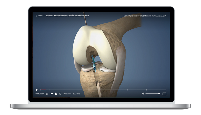 Torn ACL Reconstruction - Quadriceps Tendon Graft Animation