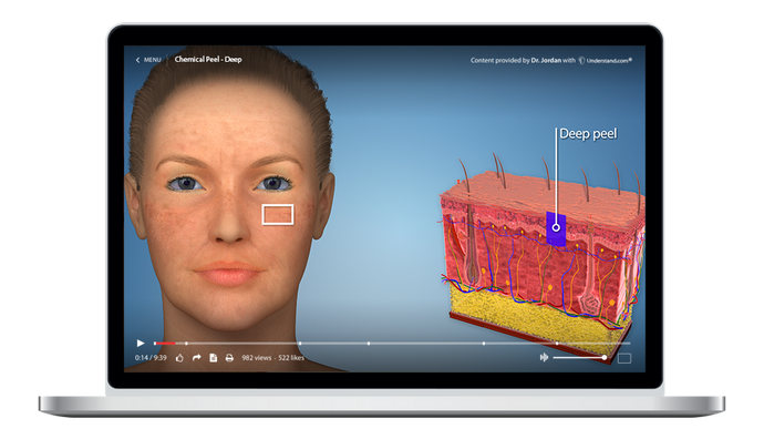 Chemical Peel - Deep Animation