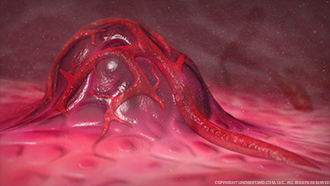 Liver Tumor Image