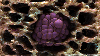 Lung Tumor Image