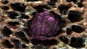 Lung Tumor Image