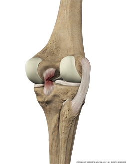 Torn PCL Posterior Extended Image