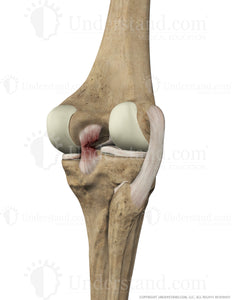 Torn PCL Posterior Extended Image