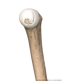 Shoulder Damaged Cartilage Medial Image