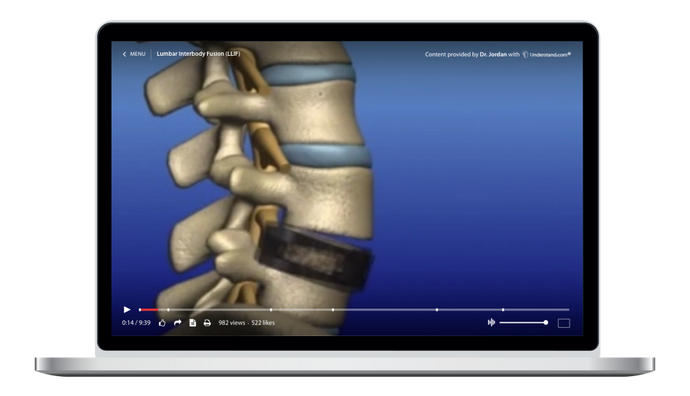 Lumbar - Lateral Lumbar Interbody Fusion (LLIF) Animation