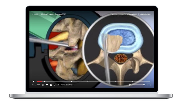 Lumbar - Minimally Invasive Approach (TLIF) Animation