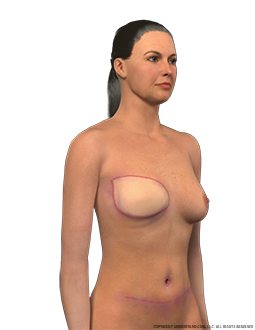 Mastectomy Scars Image