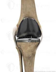 Total Knee Replacement Anterior Extended Image