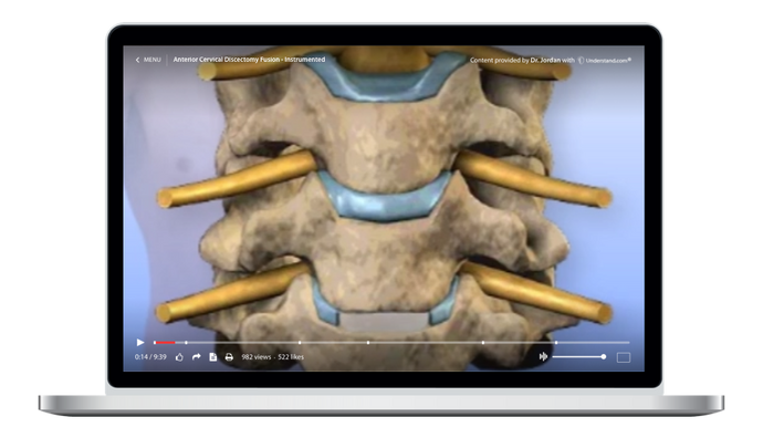 Cervical - Anterior Cervical Discectomy, Fusion - Instrumented Animation