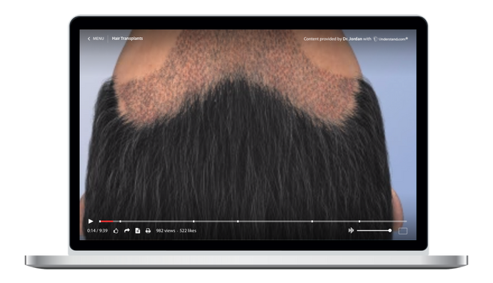 Hair Transplants Animation