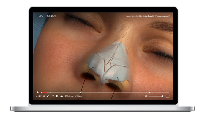 Nose Reshaping (Rhinoplasty) Animation