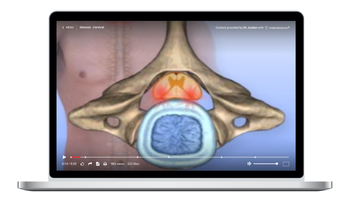 Stenosis - Cervical Animation