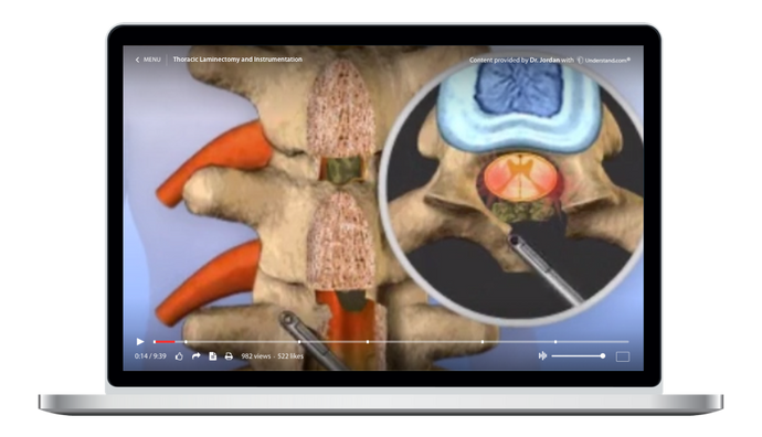 Thoracic - Thoracic Laminectomy and Instrumentation Animation