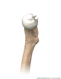 Hip Loose Bodies Medial Image