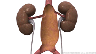 Aortic Aneurysm Image