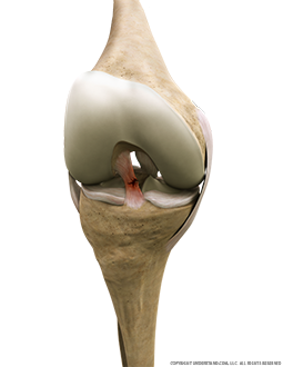 Torn ACL Anterior Flexed Image
