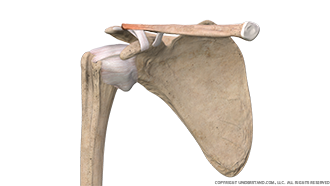 Shoulder Osteolysis Anterior Image