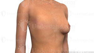 Before Breast Reconstruction Image