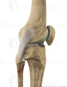Fibular Fracture Lateral Extended Image