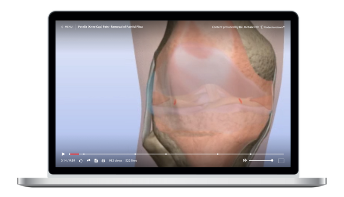 Patella (Knee Cap) Pain - Removal of Painful Plica Animation