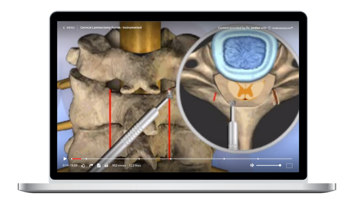 Cervical - Cervical Laminectomy, Fusion - Instrumented Animation