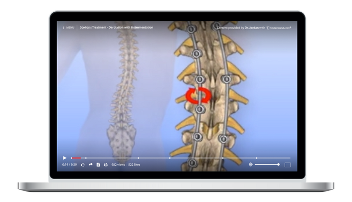 Thoracic - Scoliosis Treatment Derotation with Instrumentation Animation