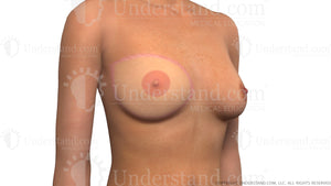 After Breast Reconstruction Image