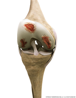 Knee Osteoarthritis Anterior Flexed Image
