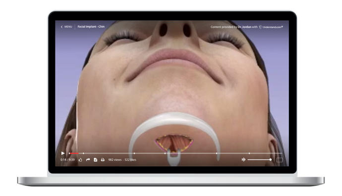 Facial Implants - Chin Animation