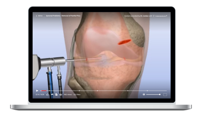 Synovial Problems - Removal of Painful Plica Animation