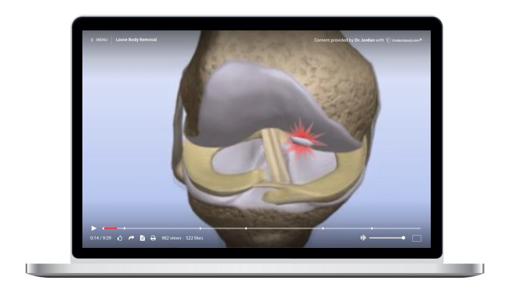 Loose Body Removal Knee Animation