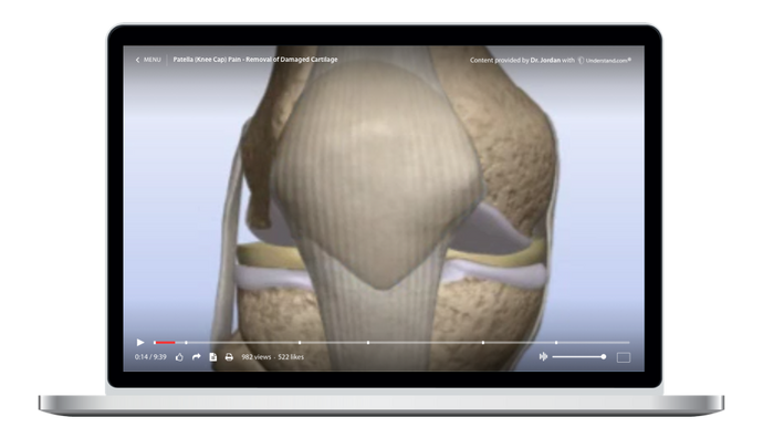 Patella (Knee Cap) Pain - Removal of Damaged Cartilage Animation