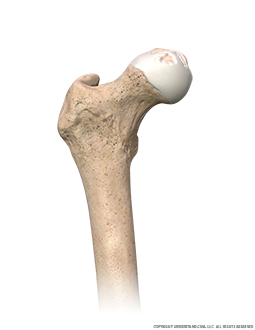 Hip Osteonecrosis Anterior Image