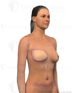 Mastectomy Scars Image
