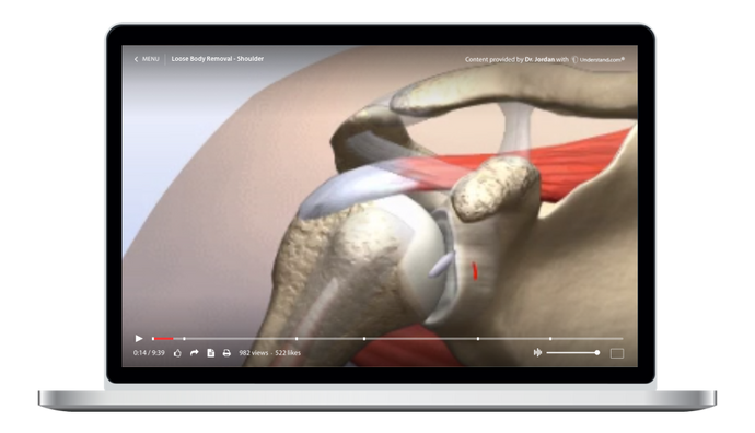 Loose Body Removal - Shoulder Animation