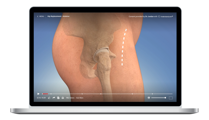 Hip Replacement - Anterior Animation