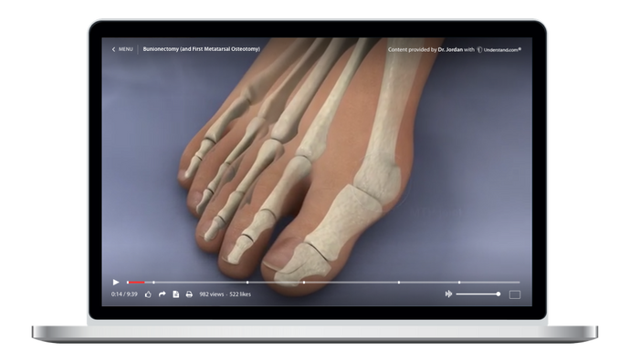 Bunionectomy (and First Metatarsal Osteotomy) Animation