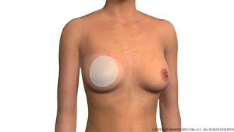Breast Reconstruction Implant after Flap Procedure Image