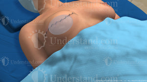 Two Stage Breast Implant Reconstruction Stage 2 Image
