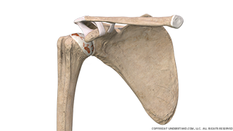 Shoulder Osteoarthritis Anterior Image